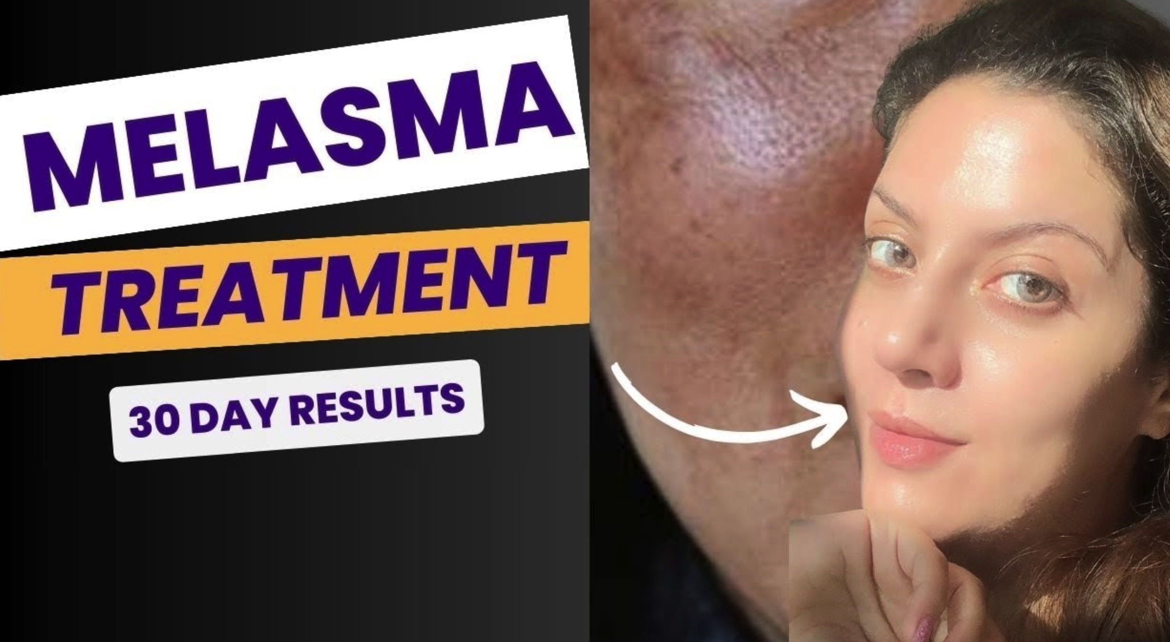Melasma